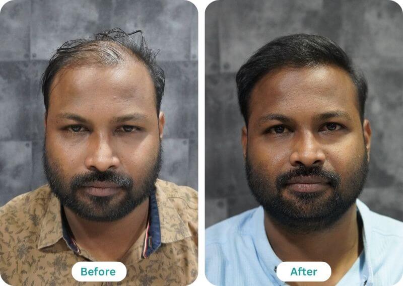 Hair Transplant Result Before And After